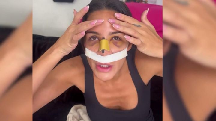 Tamara Gorro se sometió a una cirugía de nariz y su rostro desconcierta a su propio móvil